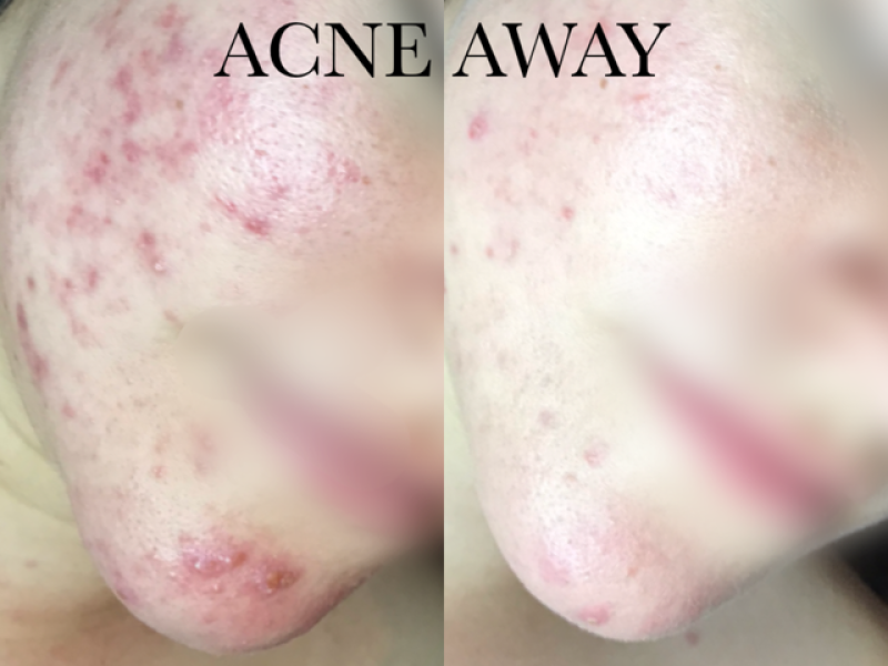 Acne verbeterd door de acne away methode toe te passen.