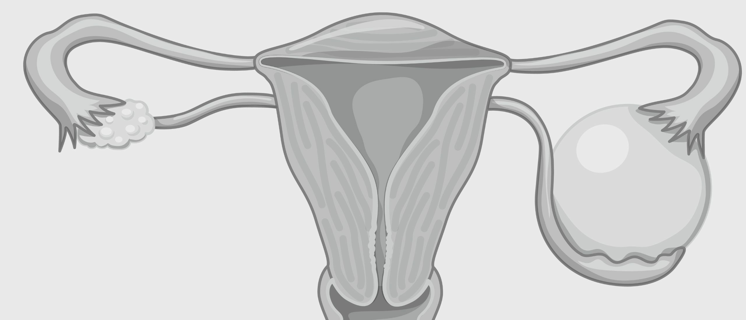 Polycysteus ovariumsyndroom uitgelegd: een gids voor ovariële gezondheid bij PCOS