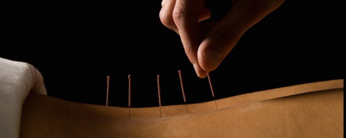 Acupunctuur: Wat is Acupunctuur en hoe werkt het?