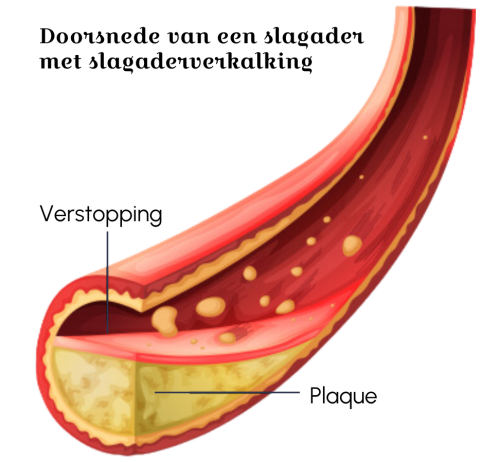 doorsnede-van-een-slagader-met-slagaderverkalking-annekiekiers-nl
