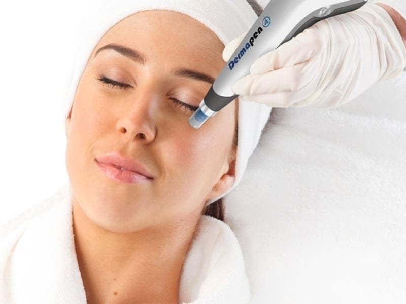 Microneedling Rotterdam