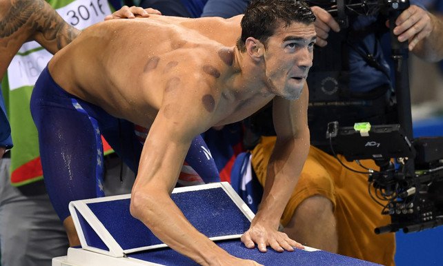 Michael Phelps en andere topsporters maken gebruik van cupping therapie