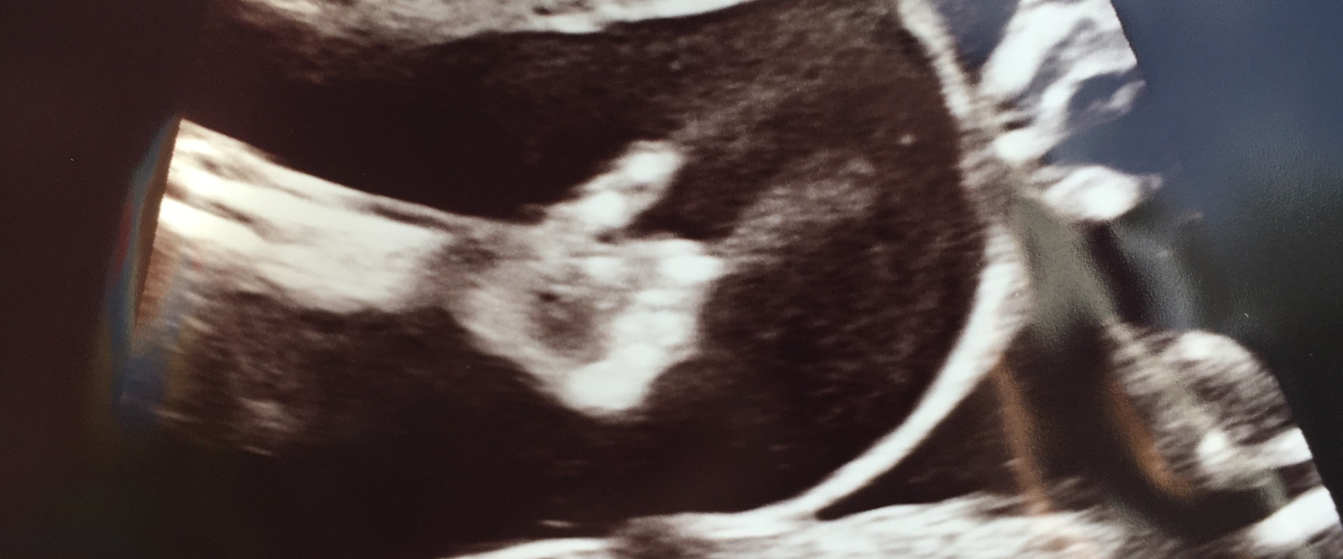 20 weken zwanger van onze tweeling, en alles gaat goed :-)