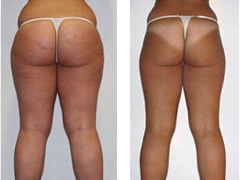 cellulite