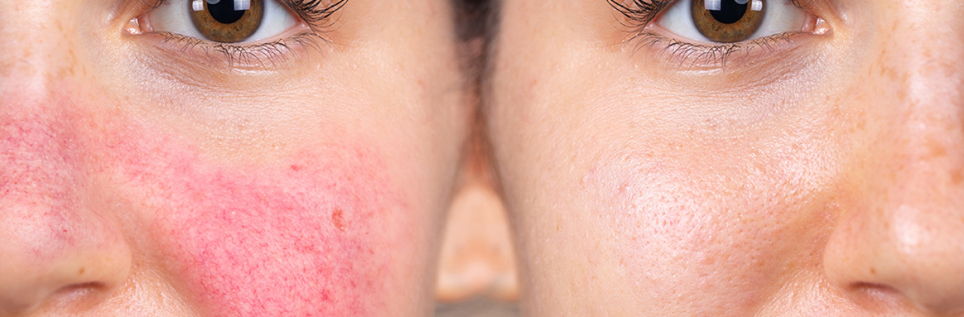 rosacea
