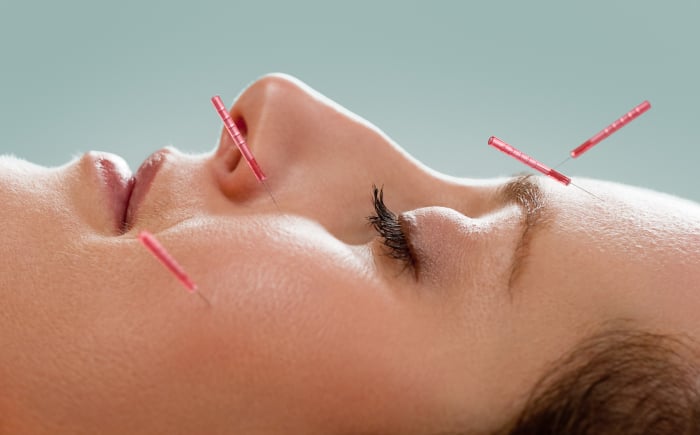 cosmetische acupunctuur Eindhoven en anti aging