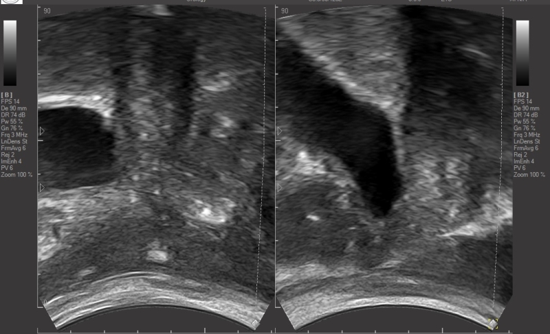 echografie bij een verzakking prolaps bekkenfysiotherapie