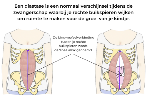 Herstel buikspieren na zwangerschap