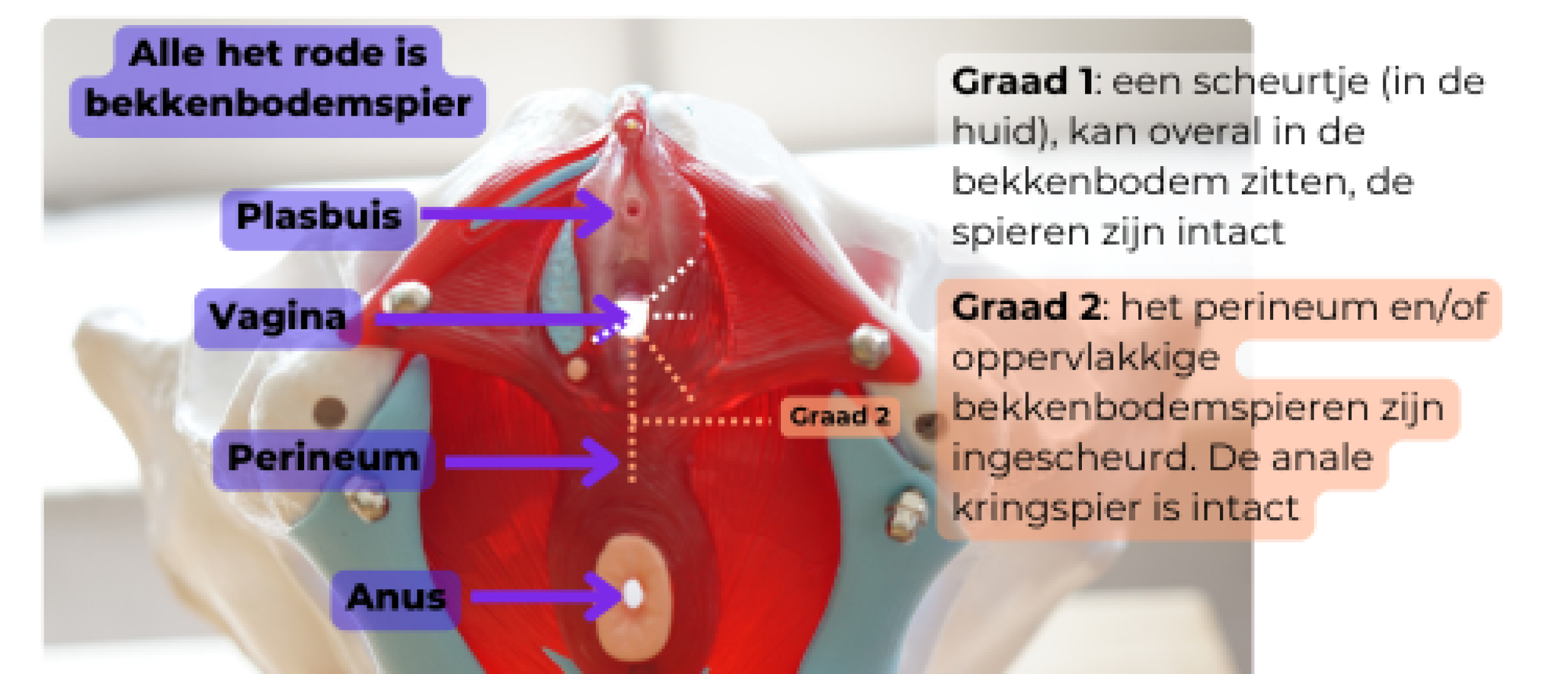 Een tweedegraads ruptuur tijdens de bevalling