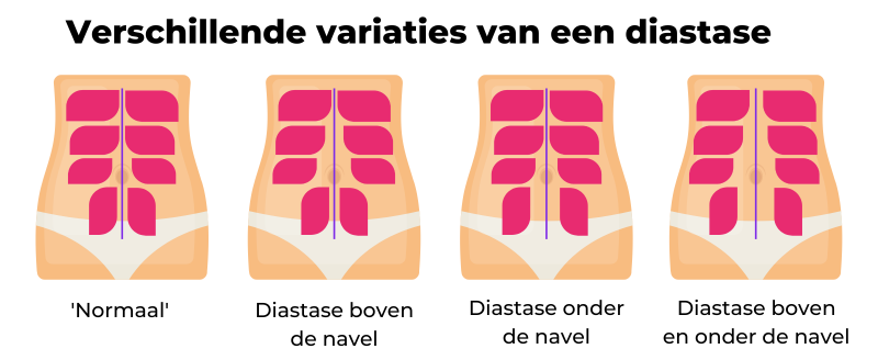 Diastase - Herstel diastase na bevalling - buikspieroefeningen