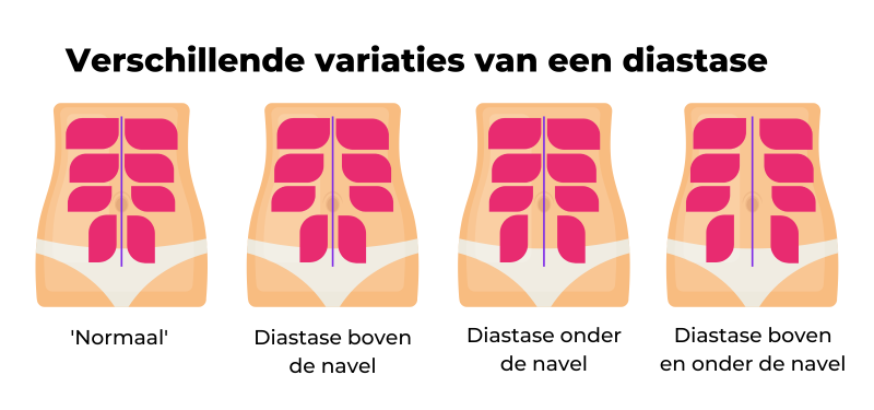 Herstel diastase na bevalling