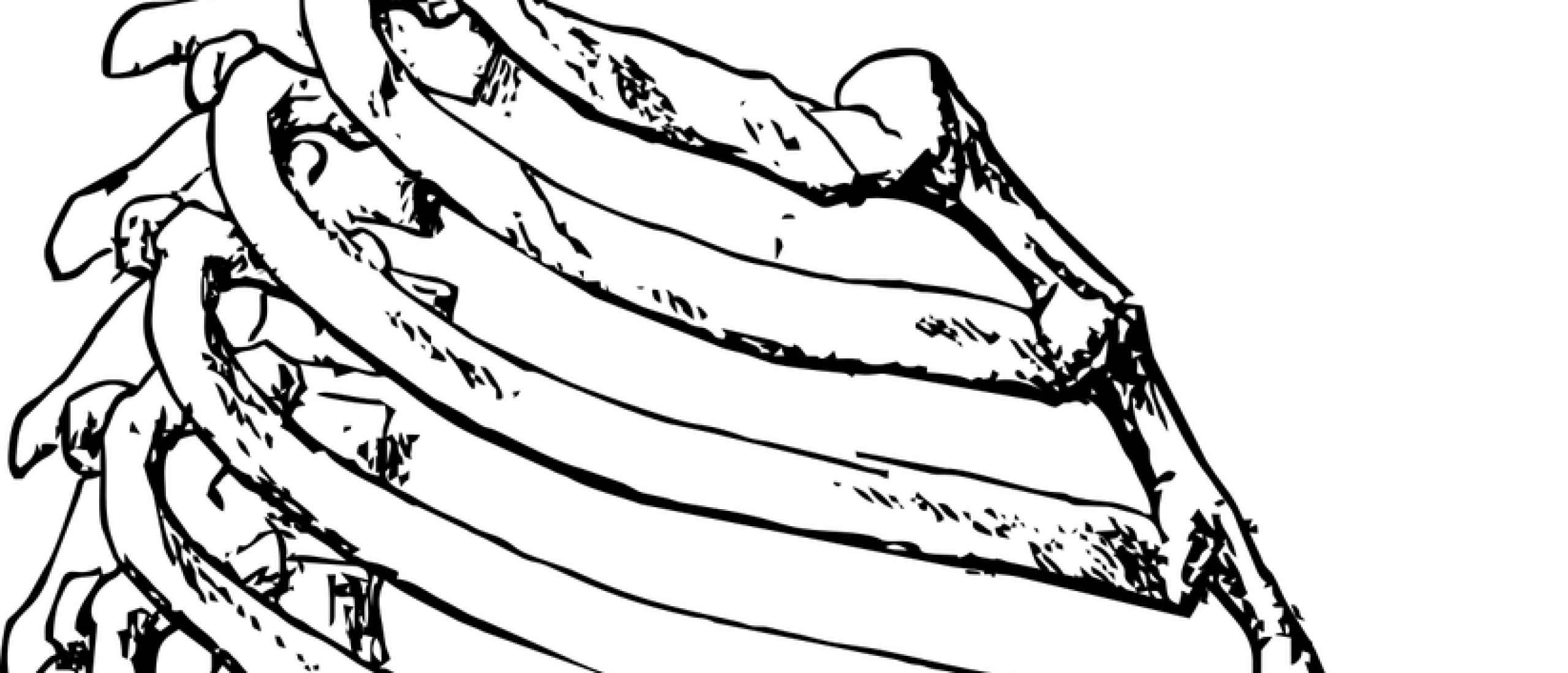 Costochondritis