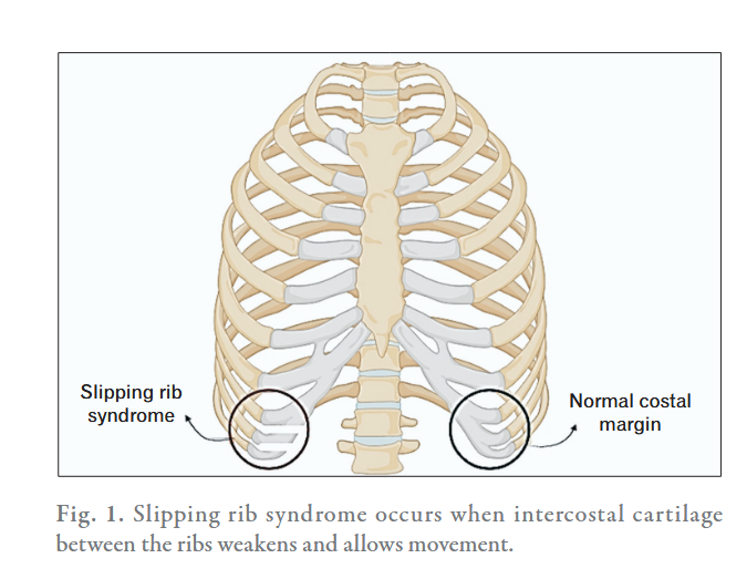 Verschil syndroom van Tietze en slipping rib syndrome