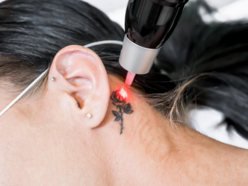 tattoo verwijderen met pico laser Eeklo
