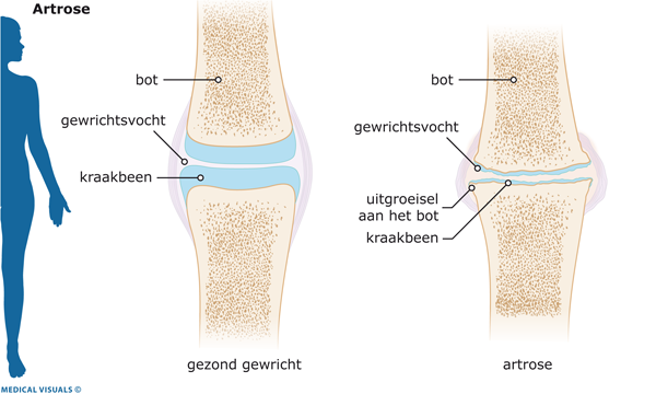 artrose-pijn-in-knie-holte