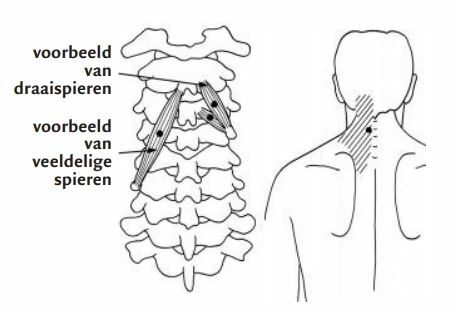 De veeldelige en rotator spieren van de nek Rotatores nekpijn, schouderpijn en stijve nek