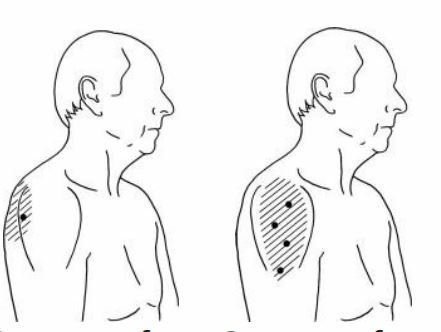deltodeus-pijn-en-spierzwakte-in-midden-en-achterkant-van-de-schouder