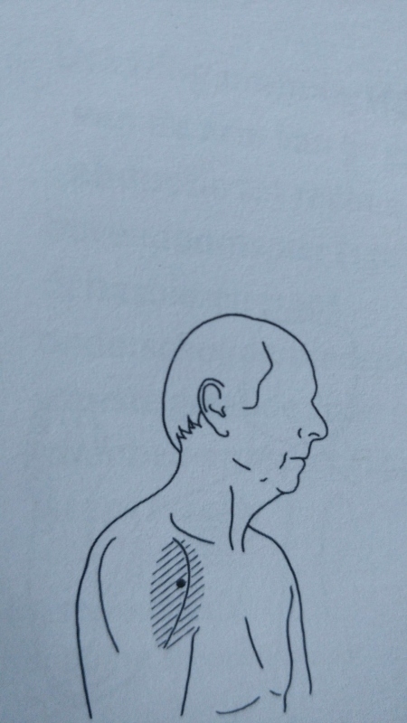 Deltoïdeus Pijn en spierzwakte in  voorkant van de schouder.JPG