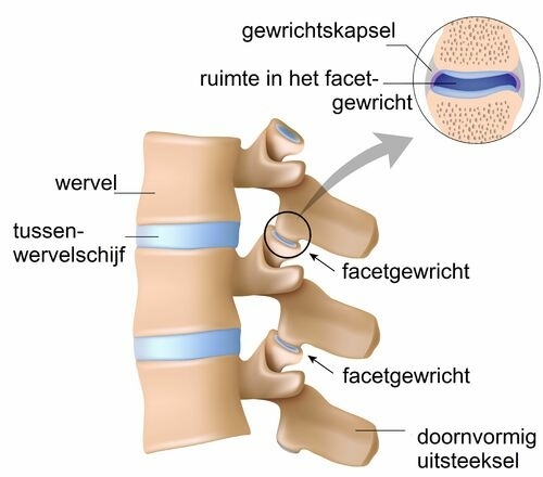 facet-artose-nek