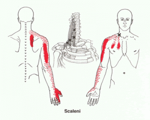 hernia-c4-c5-pijn-in-schouder-met-uitstraling-naar-bovenarm-symptomen