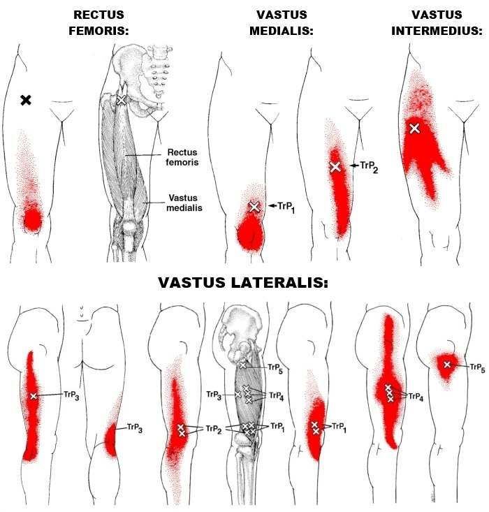 hernia-l2-l3-pijn-in-het-bovenbeen