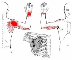 onderschouderbladspier Subscilaris pijn achterin de schouder