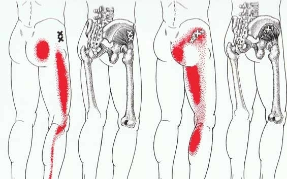 Pijn in de knieholte uitstralende pijn in been (2)