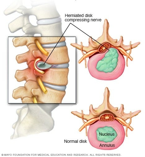 pijn-in-het-scheenbeen-hernia-ischias