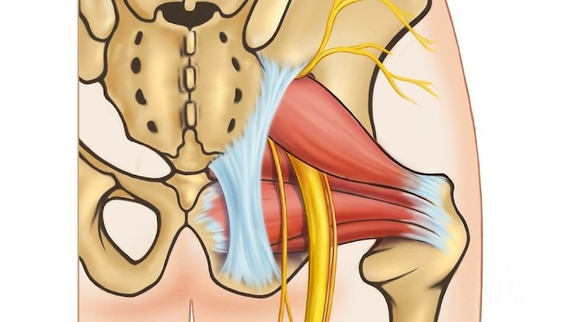 piriformis-syndroom-hoelang-duurt-dat