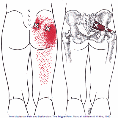 piriformis-syndroom-triggerpoint