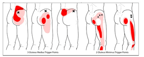 piriformis-syndroom-triggerpoints