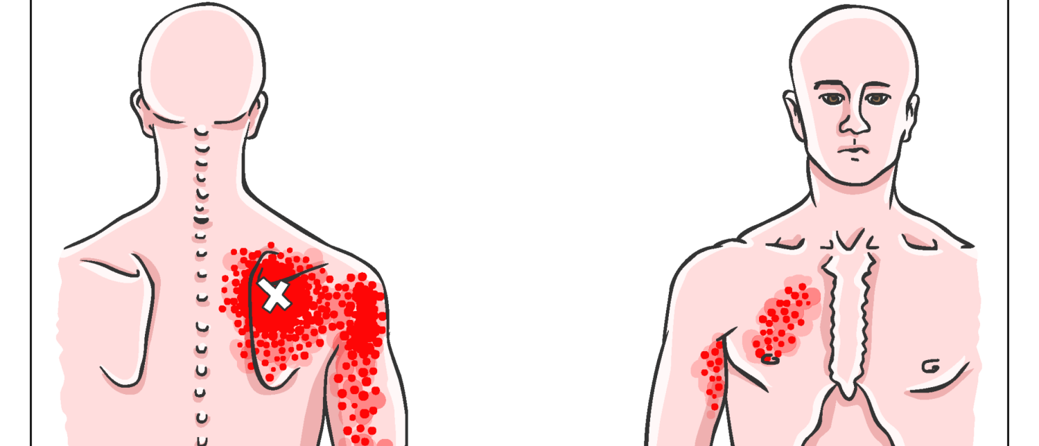 Alles over Triggerpoints schouder en schouderklachten