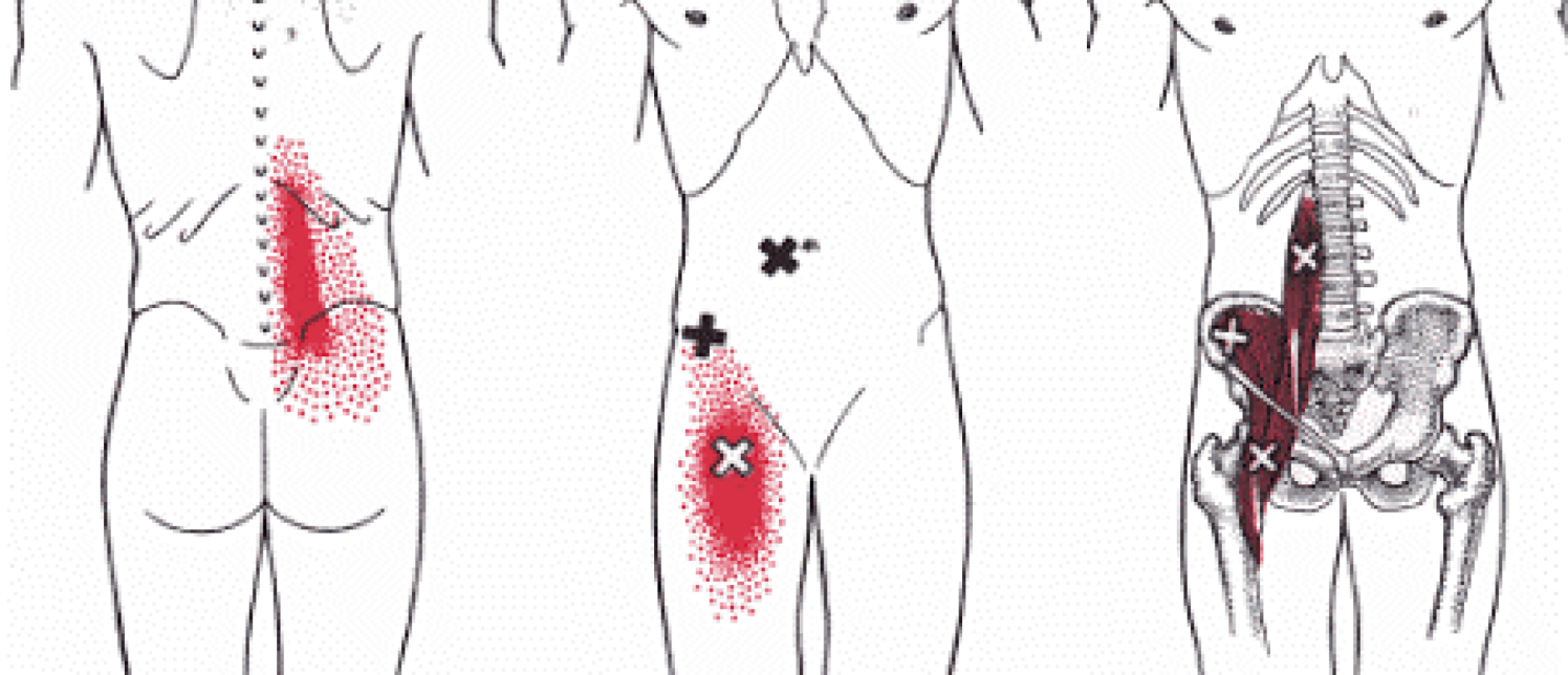 Alles Over Iliopsoas Spier- Klachten En Behandeling