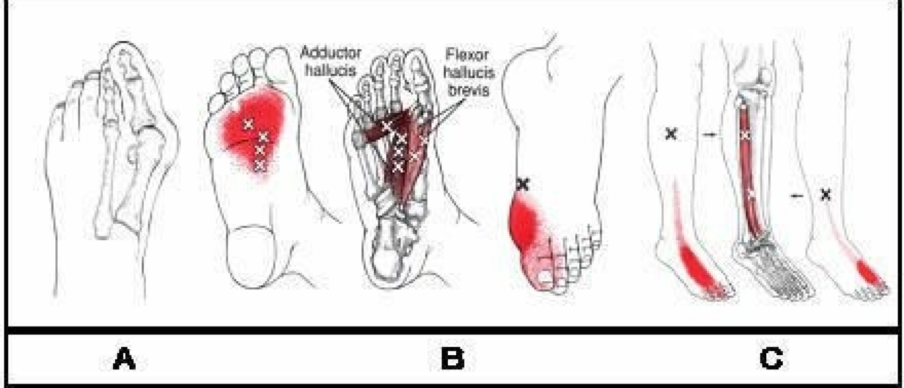 Tintelingen in de voeten ontdek de