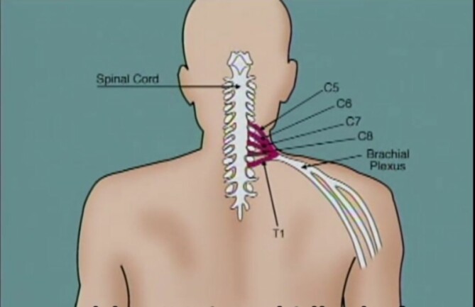 Alles over pijn in de bovenarm- oorzaken en behandeling