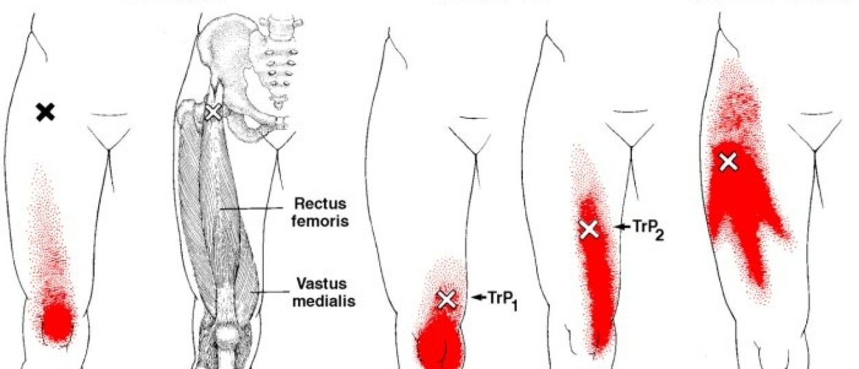 Alles over Pijn het Bovenbeen oorzaken en behandeling