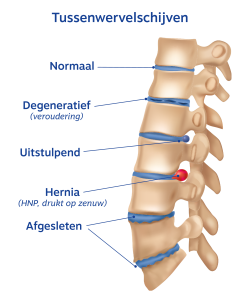 soorten-hernias-l4-l5-f