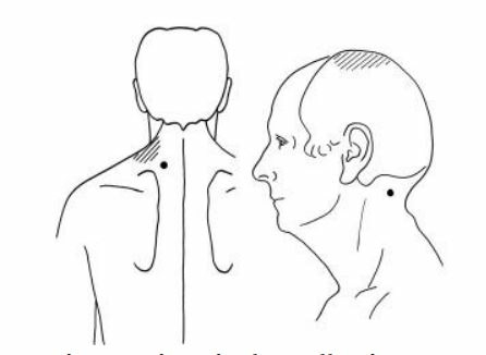Spalkspier nek Splenius Cervicis ) stijve nek pijn onderin de nek en hoofdpijn