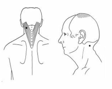 Spalkspier van het hoofd Splenius Capitis stijve nek, pijn in de nek, whiplash en hoofdpijn
