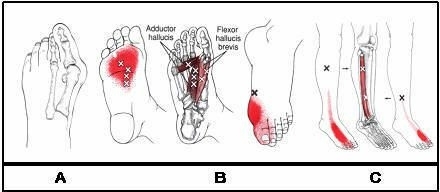 tintelingen-in-de-voet-symptomen-1