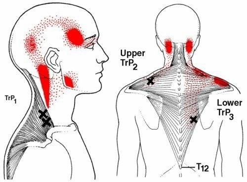 Triggerpoint nek trapezius monnikkapspier  pijn in de boven- en achterkant van de schouder