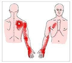 Triggerpoint schouderblad pijn op de borst