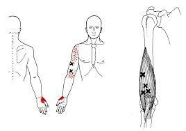 triggerpoints-de-bovenarmspier-brachialis-pijn-duim-elleboog