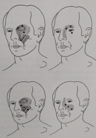 triggerpoints-hoofdpijn-kringspier-van-het-oog-orbicularis-oculi