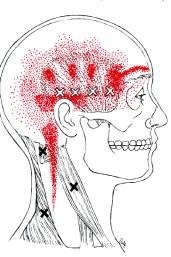 triggerpoints-hoofdpijn-migraine-tension-myositis-syndroom