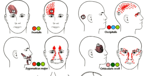 triggerpoints-hoofdpijn-onder-de-hoofdhuid-voorhoofd-kruin-achterhoofd-op-het-hoofd