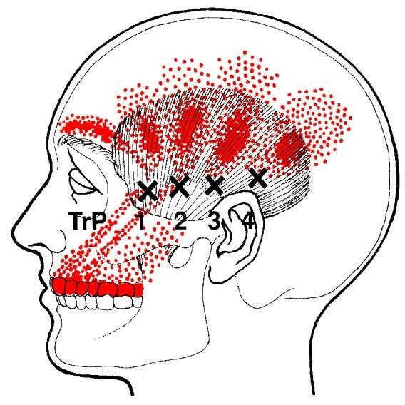 triggerpoints-hoofdpijn-slaapbeen-spier-temporalis