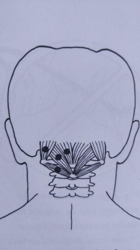 triggerpoints-hoofdpijn-suboccipitale-spierende-onderachterhoofdspieren