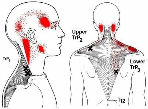 triggerpoints-hoofdpijn-traoezius-monnikskapspier-