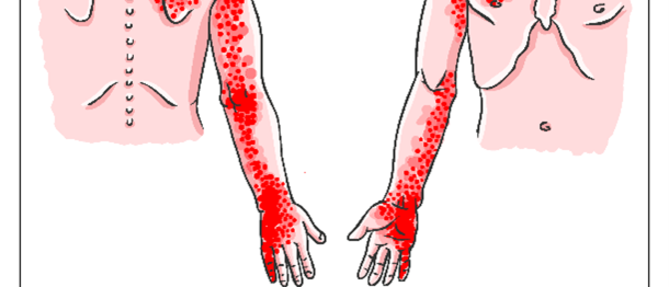 Triggerpoints in de bovenarm, elleboog, onderarm, hand, duim en vingers